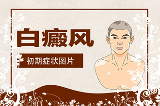 白癜风患者在饮食方面的注意事项